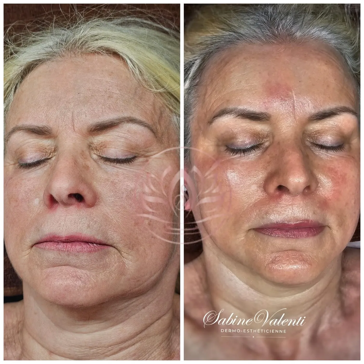 Soin Plasma Froid du visage, avant et après