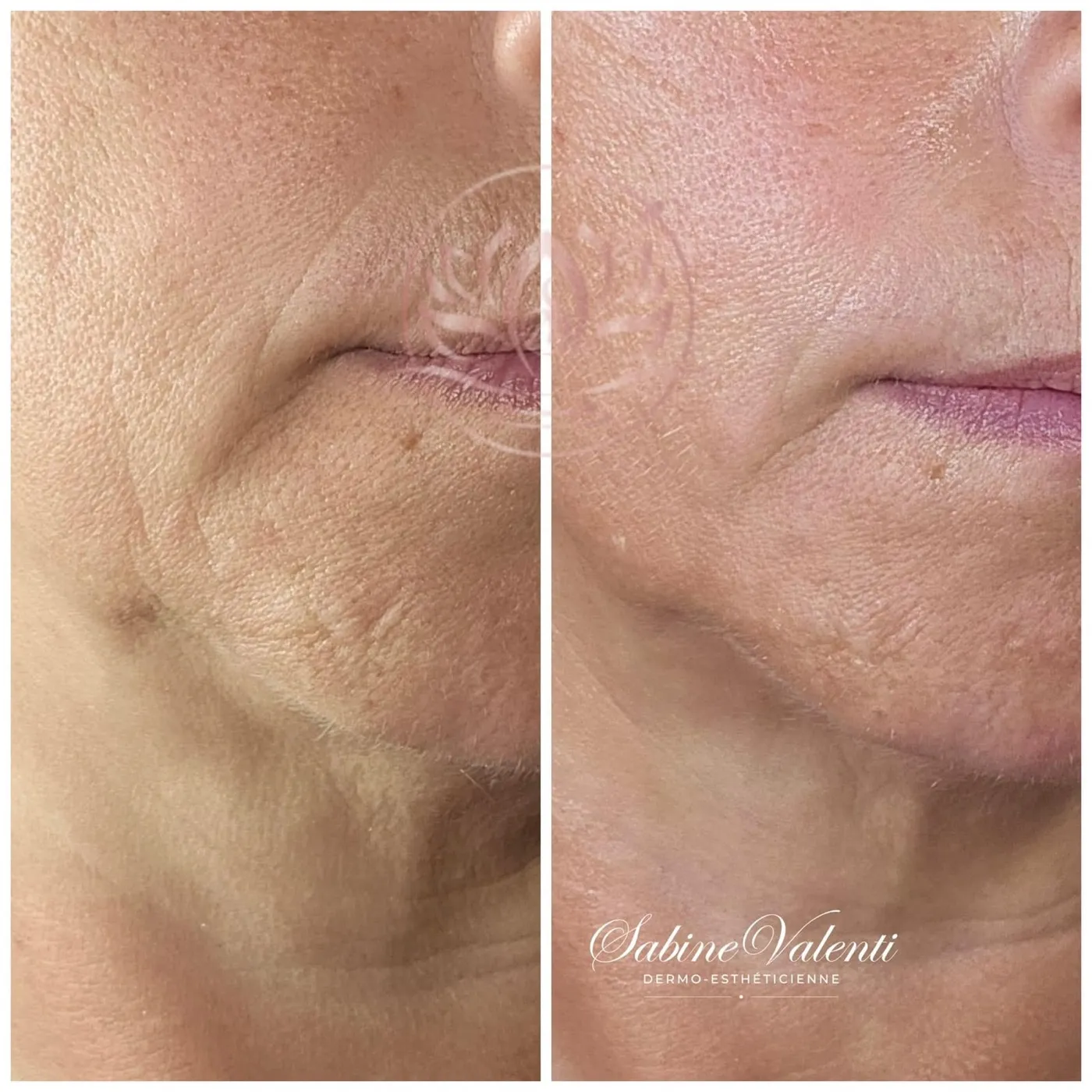Plasma Froid, contour de la bouche lissé, avant et après